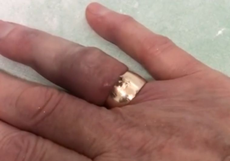 Южноуральские спасатели помогли пенсионерке снять кольцо, которое она носила полвека